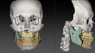 IPS CaseDesigner® – Tutorial 4